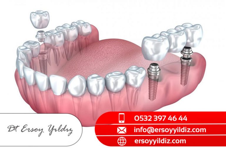 Göztepe İmplant Tedavisi Hakkıda Ersoy Yıldız İmplant